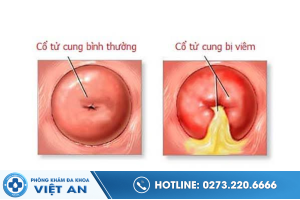 viem-loet-co-tu-cung